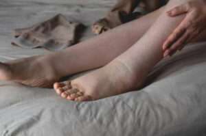 Una persona con edema linfatico Meige, mostrando una parte del proprio corpo, la caviglia e il tallone, con la pelle di una gamba ben definita